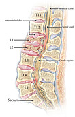 Lumbar Compression Fracture