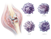 Rheumatoid Arthritis White Blood Cells