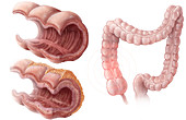 Crohn's Disease Progression