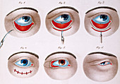 Surgery to Correct Ptosis,1830
