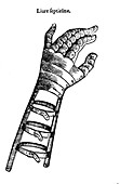 Artificial Hand Designed by Ambroise Pare