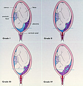 Grades of Placenta Praevia