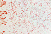 Lichen Myxedematosus and Scleromyxedema