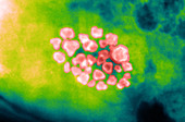 Gallstones (X-ray)