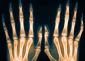 Marfan's Syndrome,X-ray