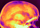 Normal encephalogram