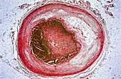 Thrombosis & Atheroma,LM