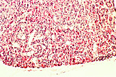 Benign Adenoma in Parathyroid Gland,LM
