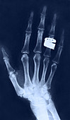 Hand with Rings,X-ray