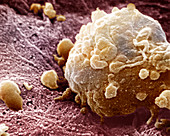 Melanoma cancer cell,SEM