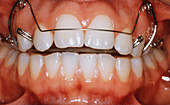 Upper Brace for Incisors