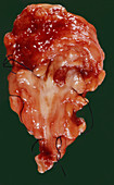 Kidney Papilloma