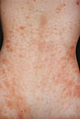 Seborrheic Dermatitis
