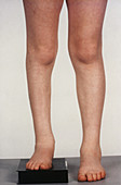 Paralytic Short Leg