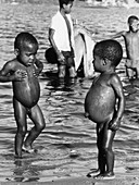 Malnourished Children,Brazil