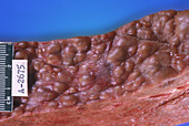 Cirrhosis,Human Liver