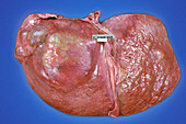 Liver with Tumour