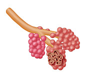 Alveoli Damaged By Emphysema