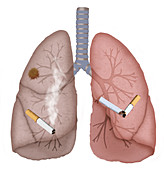 Healthy and Cancerous Lungs