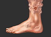 Skin Ulcer from a Varicose Vein