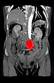 CT Scan of Abdominal Aortic Aneurysm