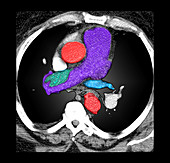 colour Enhanced CT of Pulmonary Embolus