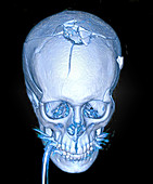 3D Reconstruction Gunshot Injury to head