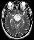Craniopharyngioma (MRI)