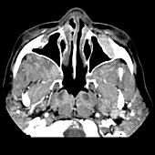 Orbital and Deep Facial Lymphoma