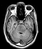 Brainstem Glioma in Child (MRI)