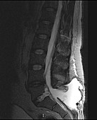 Postoperative Pseudomeningocele (MRI)