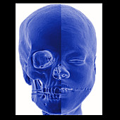 Human Face and Skull,Enhanced 3D CT Scan
