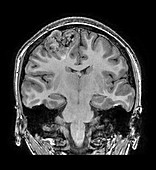 Oligodendroglioma (MRI)