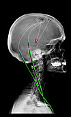 Parkinson's Disease with DBS Electrodes