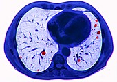 Lung Metastases
