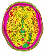 MELAS Syndrome,Brain MRI