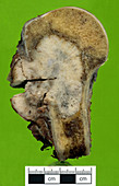 Femur with Metastatic Adenocarcinoma