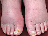 Edema (Swelling) of feet