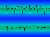 Atrial Fibrillation and Normal Heart Beat