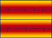 Atrial Flutter and Normal Heart Beat