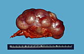 Damaged Kidney from Stones in Ureter