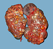 Polycystic Disease of Kidneys