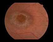 Bull's-Eye Retinopathy