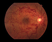 Central Retinal Vein Occlusion