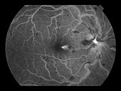 Central Retinal Vein Occlusion