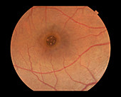 Macular Hole