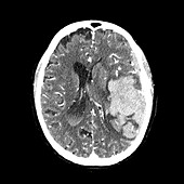 CT Angiogram of Large Cerebral Hemorrhage