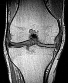 Knee Arthritis,MRI
