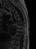 Thoracic Vertebrae Compression Fracture