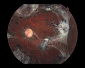 Proliferative Diabetic Retinopathy